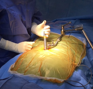 écarteurs tubulaires